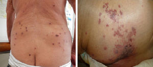 Caso 2: En la imagen de la izquierda observamos paciente con lesiones costrosas sobre base eritematosa localizadas en tronco. Caso 3: En la imagen de la derecha observamos las lesiones típicas de herpes zoster en dermatomo S1 a S3, en forma de vesículas y costras agrupadas sobre base eritematosa, localizadas en glúteo izquierdo. La paciente desarrolló a los 5 días lesiones generalizadas.