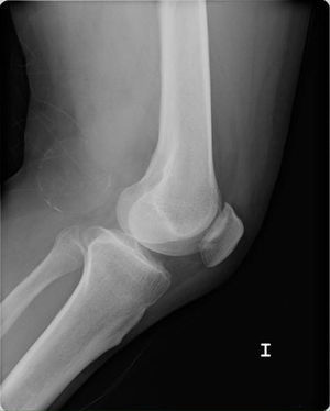 Radiografía lateral de rodilla izquierda.