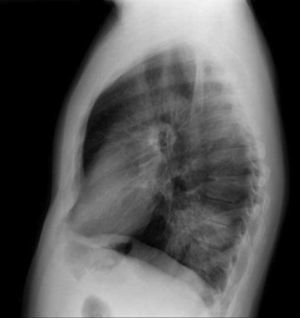Radiografía de tórax proyección PA.