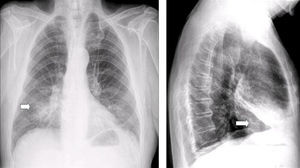 Radiografía de tórax. AP (izquierda) y perfil (derecha): condensación en lóbulo medio y língula (flecha blanca).