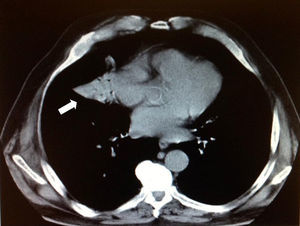 TAC torácico, corte transversal: condensación triangular, con base en mediastino (flecha blanca).