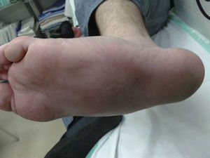 Desaparición de bóveda plantar, no se aprecian hematomas o crepitación y los pulsos pedios aparecen conservados y simétricos.