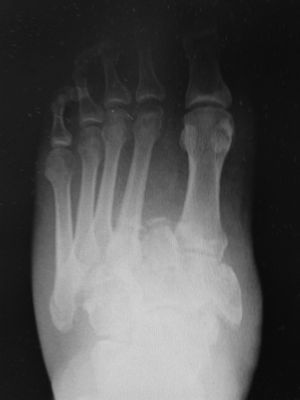 Radiografía anterposterior, lateral y oblicua de pie donde se objetiva fractura-luxación tipo Lisfranc con afectación a varios niveles de la articulación tarso y metatarsal.