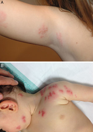 A. Caso 3: placas anulares eritematosas, con lesiones vesiculosas transparentes agrupadas y otras en fase de costra. B. Caso 4: herpes zóster en dermatomas C2-C4. Pápulas y vesículas eritematosas agrupadas en la hemicara izquierda y el brazo ipsilateral.