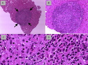 A. Cilindro hepático con granuloma no caseificante bien delimitado (flechas). B. Granuloma no caseificante de tipo sarcoideo aumentado de tamaño. C. Histiocitos epiteloides de tipo «cuerpo extraño» con citoplasma espumoso y núcleos periféricos (asteriscos). D. Infiltrado inflamatorio de naturaleza linfocitaria.
