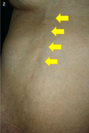La paciente presentaba la tumoración lineal a nivel submamario derecho que se observa en las fotografías (señalada con flechas).