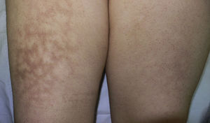 Máculas eritemato-violáceas, con patrón reticular, localizadas en ambos muslos con más intensidad en el derecho.