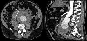 Corte axial y sagital de TC mostrando aneurisma de aorta abdominal con luz arterial replecionada de contraste (flecha negra) y gran hematoma alrededor conteniendo la rotura (flecha blanca).