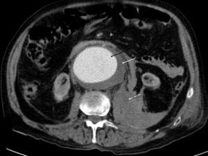 Corte axial de TC con aneurisma de aorta abdominal infrarrenal (flecha negra) con trombo mural (flecha blanca) y hematoma retroperitoneal en espacio pararrenal posterior izquierdo (flecha blanca discontinua).