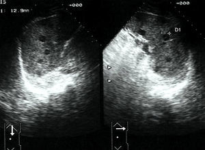 Afectación esplénica por linfoma. Corte longitudinal y transversal de bazo. Se observan imágenes hipoecogénicas redondeadas y bien definidas distribuidas por todo el parénquima del bazo.