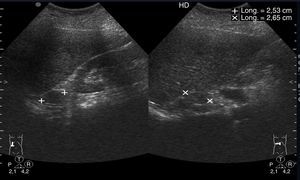 Adenoma suprarrenal. Corte longitudinal (izquierda) y transversal (derecha) en hipocondrio derecho a nivel de línea axilar. Se observa un nódulo sólido hipoecogénico, redondeado, en el área teórica de la glándula suprarrenal derecha.