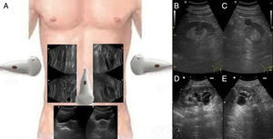 A: colocación de la sonda e imágenes ecográficas en los 2 cortes típicos de la exploración del aparato urinario. B: riñón en longitudinal con hipertrofia de columna de Bertin. C: riñón en transversal con quiste cortical. D y E: riñón con quistes sinusales en corte longitudinal y transversal.