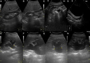 A y B: riñón con litiasis en grupo calicial inferior en cortes longitudinal y transversal. C: riñón en corte transversal con 2 litiasis en la pelvis mayor y otra en la porción proximal del uréter. D: uréter distal visto usando la vejiga como ventana acústica y que contiene una imagen de litiasis y presenta dilatación. E: corte longitudinal de un riñón con hidronefrosis leve. F y G: corte longitudinal y transversal de un riñón con hidronefrosis moderada. H: corte longitudinal de un riñón con hidronefrosis severa.