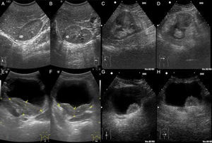 A y B: corte longitudinal y transversal de una lesión nodular hiperecogénica en cortical renal compatible con angiomiolipoma como primera opción. C y D: cortes longitudinal y transversal de una gran lesión nodular isoecogénica con la cortical renal, excrecente desde esta, siendo el carcinoma de células renales el diagnóstico más probable. E y F: corte longitudinal y transversal de una vejiga con una masa de crecimiento en el espesor de la pared, probable carcinoma de células transicionales no papilar. G y H: corte longitudinal y transversal de una vejiga con una lesión nodular dependiente de pared creciente hacia la luz, probable carcinoma de células transicionales papilar.