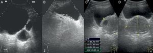 A: corte longitudinal de una vejiga con pared posterior engrosada y trabeculada típica de una vejiga de lucha. B: corte transversal de una vejiga con 2 divertículos en su cara posterolateral izquierda. C y D: corte longitudinal y transversal de una próstata con crecimiento grado iv y con un quiste (en otros cortes se veía claramente el refuerzo posterior).