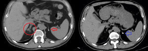 TC abdominal que muestra las glándulas suprarrenales aumentadas de tamaño con quistes, y en la que ya se observó una pequeña calcificación en la suprarrenal izquierda (flecha); todo ello es compatible con enfermedad tuberculosa.