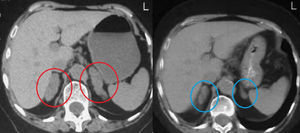 TC abdominal. Se observan glándulas suprarrenales muy aumentadas de tamaño de forma bilateral, con un contorno globuloso y nodular (izquierda). Tras 2 años de seguimiento se repitió la TC y se objetivó que las glándulas habían disminuido de tamaño (derecha).