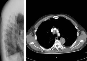 Rx de columna dorsal. TAC toraco-abdominal con masa de 4cm de diámetro en segmento posterior de LSI que contacta con pleura visceral y cisura oblicua. Metástasis ósea en D5 y tumoración de partes blandas que protruye hacia la cavidad torácica.