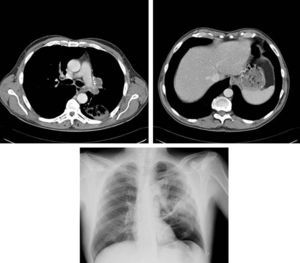 Rx de tórax con imagen nodular de 18,5mm suprahiliar con tracción apical del hilio izquierdo. TAC toraco-abdominal con tumoración de 45mm de diámetro en hilio pulmonar izquierdo que engloba el bronquio principal, el bronquio del segmento 6,y que estenosa el bronquio del lóbulo inferior. Destrucción de articulación costovertebral izquierda que en T9 produce efecto masa en partes blandas y protruye sobre parénquima pulmonar.