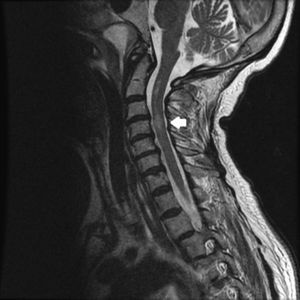 Corte sagital en secuencia T2 de la RM cervical donde se aprecian los mencionados cambios hiperintensos desde C2 hasta C5.