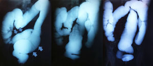 Enema opaco, dolicomegacolon chagásico, importante dilatación sigmoidea (flechas).