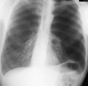 Enfisema bulloso severo de predominio en lóbulos superiores.