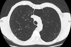 Bullas bilaterales asociadas a enfisema centrolobulillar que afectan principalmente a campos pulmonares medios y superiores.
