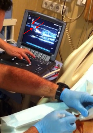 Momento en el que el enfermero de urgencias le está realizando la gasometría arterial a la paciente, canalizando la arteria radial derecha. Podemos observar, en la pantalla del ecógrafo, cómo la aguja (flechas) se encuentra en el interior de la arteria.