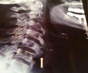Radiografía lateral de columna cervical mostrando marcada hiperostosis (flecha).