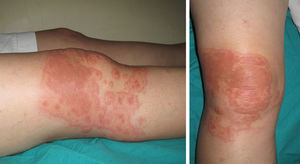 Caso 1. Placa eritematosa ligeramente elevada con bordes bien definidos, y formada por la confluencia de varias lesiones con morfología en diana. Fuente: Servicio de Dermatología, Hospital Universitario Virgen de las Nieves.