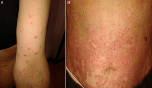 Caso 2. A) Pápulas eritematosas con alguna vesículas localizadas en abdomen. B) Pápulas y placas de aspecto dianiforme con zona central violácea y periferia eritematosa. Fuente: Servicio de Dermatología, Hospital Universitario Virgen de las Nieves.