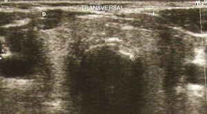 Ecografía tiroidea del paciente en proyección transversal que muestra una densidad heterogénea de la glándula, zonas hipoecogénicas y un nódulo mixto de predominio quístico en el lóbulo derecho. Fuente: imagen cedida por el paciente.
