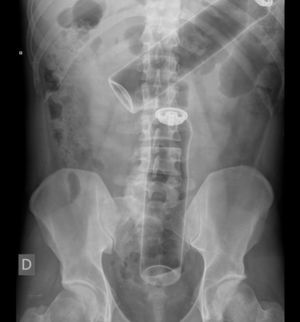 Rx de abdomen.