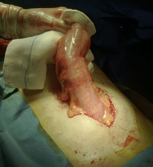 Laparotomía umbilical.