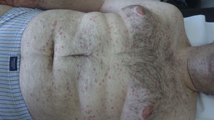 Imagen clínica del exantema maculopapular de coloración eritematosa, a nivel de tórax y abdomen.