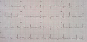 Electrocardiograma de la paciente realizado a su llegada al servicio de urgencias y varias horas después.
