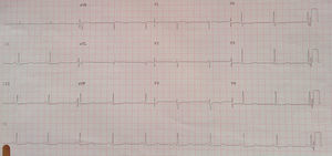 Electrocardiograma de la paciente realizado a su llegada al servicio de urgencias y varias horas después.