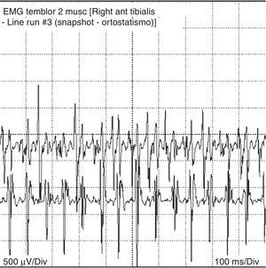 Electromiograma del músculo tibial anterior derecho.