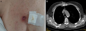 A) Imagen de la lesión esternal ulcerada. B) Imagen TAC con lesión de partes blandas, ulcerada, paraesternal derecha, entre segunda y tercera costillas. Fistulización cutánea, y continuidad en profundidad hasta espacio subpleural y región de cadena mamaria interna.