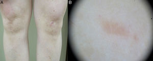 A) Lesiones eritematosas de pequeño tamaño, bilaterales, con disposición lineal de predominio en rodilla izquierda. B) Visión de lesión lineal en rodilla con dermatoscopio: se observan lesiones papulosas de coloración más oscura que la superficie cutánea.