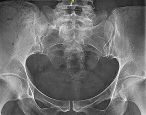 Columna lumbosacra antero-posterior: sacralización última vértebra lumbar, con aumento de la apófisis transversa izquierda que forma una diartrosis con el sacro, y fusión de la apófisis transversa derecha con el sacro (tipo IV de la clasificación de Castellvi).
