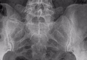 Columna lumbosacra antero-posterior: megaapófisis transversa unilateral izquierda de 33mm de dimensión craneocaudal con seudoartrosis con sacro e ilion (tipo II de la clasificación de Castellvi).