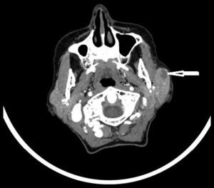 Tomografía axial computarizada cráneo-cervical, que muestra una lesión en el lóbulo superficial de la parótida izquierda de 27×20 mm.