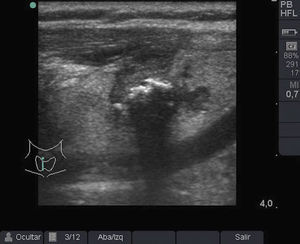 Nódulo tiroideo con calcificación central, sombra posterior y bordes mal delimitados con infiltración adyacente.