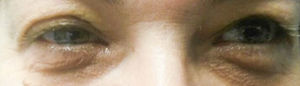 Ptosis y miosis en el ojo derecho.