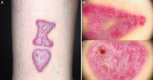 A. Placas eritematovioláceas sobreelevadas confinadas a las zonas de pigmento rojo, coincidiendo con el trazado del tatuaje. B, C. Exploración dermatoscópica en la que se observaban líneas longitudinales blanco-nacaradas compatibles con estrías de Wickham, signos característicos de las lesiones liquenoides.