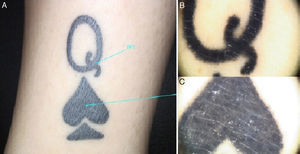 A. Tatuajes con pigmento de color negro, sin alteraciones. B, C. Exploración dermatoscópica sin hallazgos relevantes; solo se observa la homogeneidad del pigmento negro del tatuaje.