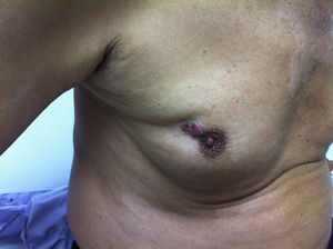 Tumoración y ulceración periareolar en la mama derecha.