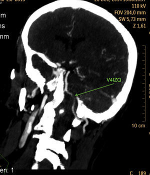 Angio-TAC de tronco supra-aórtico. Se visualiza la disección en segmento V4 de arteria vertebral izquierda.