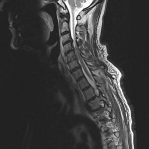 RM cervical. Corte sagital. Secuencia T1. Pinzamiento del espacio discal C5-C6 con hiperintensidad de la señal e irregularidad del cuerpo vertebral de C5 y C6 compatibles con espondilodiscitis. Protrusión discal posterior y ocupación del espacio epidural. Estenosis de canal C4-C5 y en C5-C6: se observa alteración de la señal indicativa de mielopatía cervical.